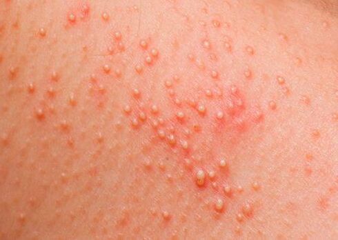 If the body is affected by parasites, a skin allergy appears