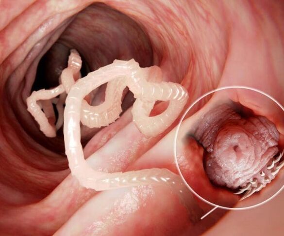 worms in the human intestine photo 2